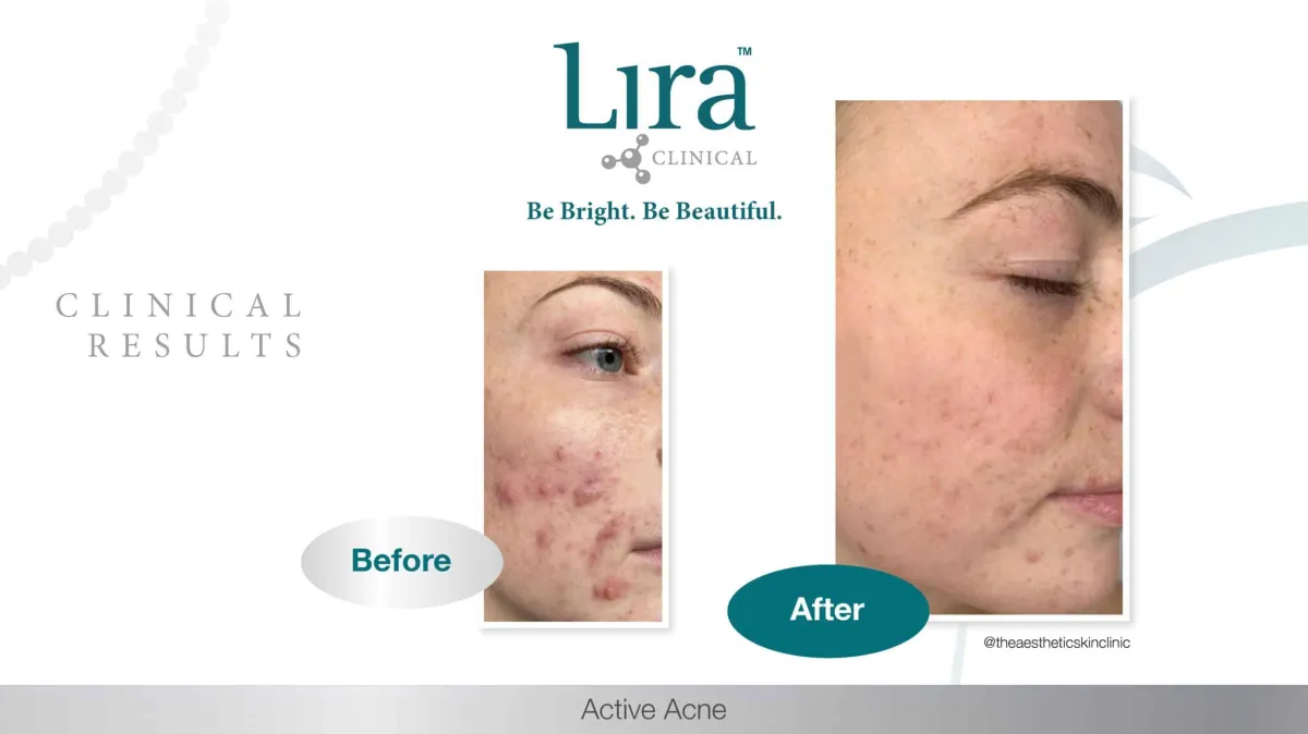 Lira Clinical - Active acne results