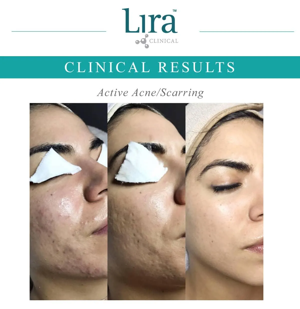 Lira Clinical - Active acne