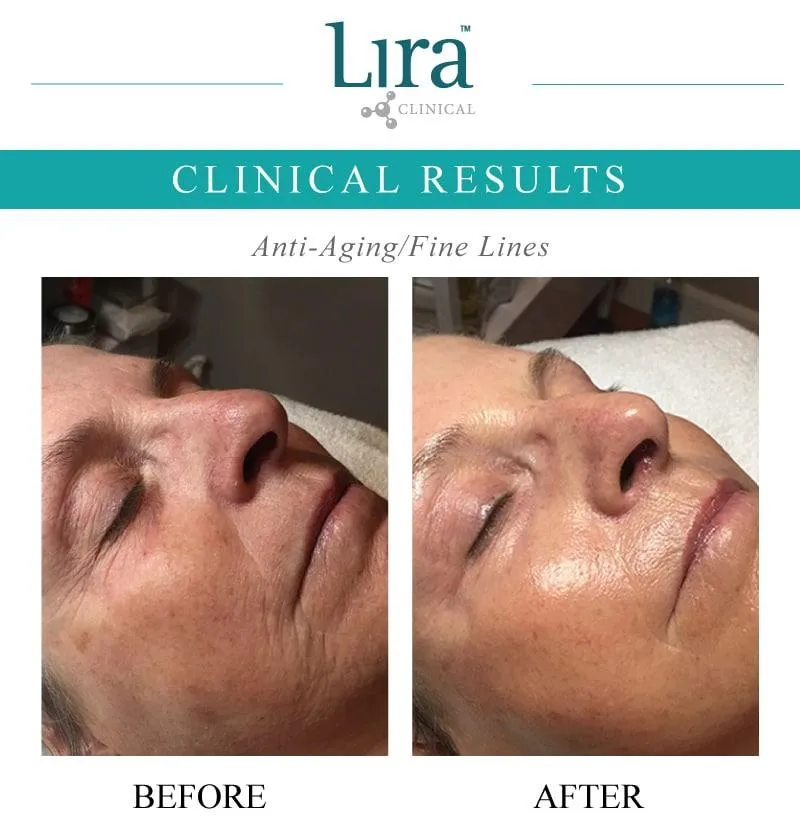 Lira Clinical Results - Ani-aging