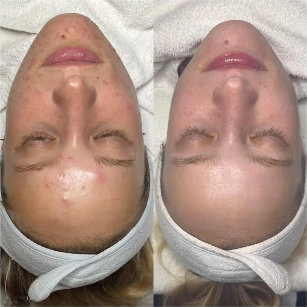 Facial Lounge OKC Acne Bootcamp 2