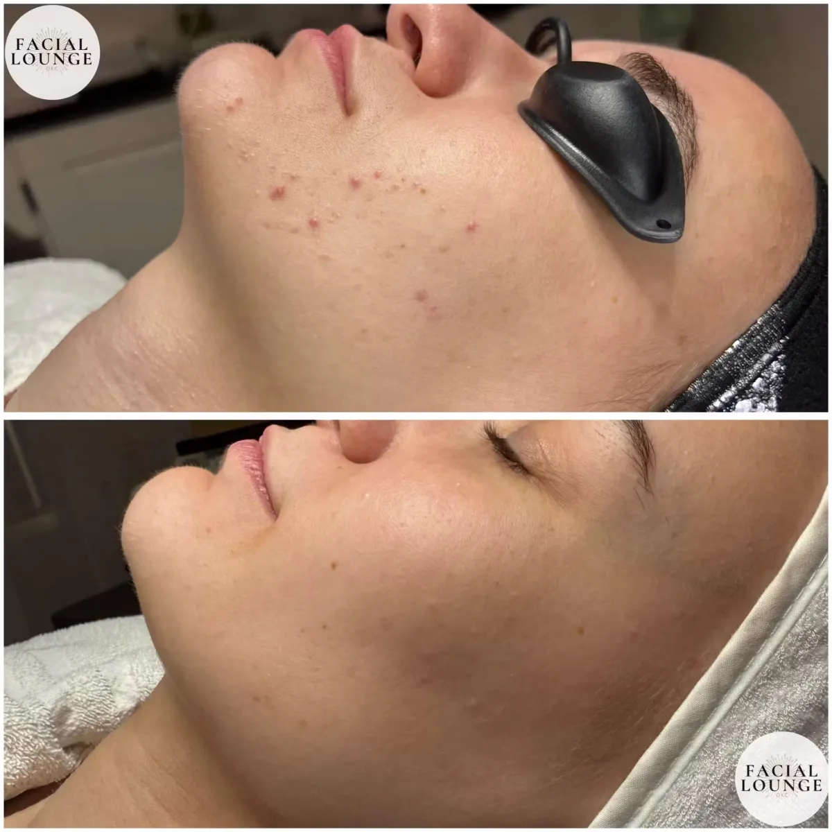 Facial Lounge Acne Bootcamp 