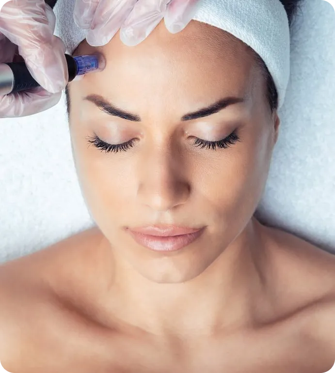 Microneedling Treatment