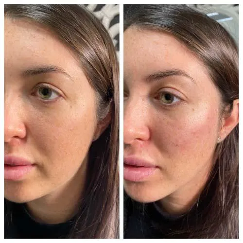 Cheek Filler