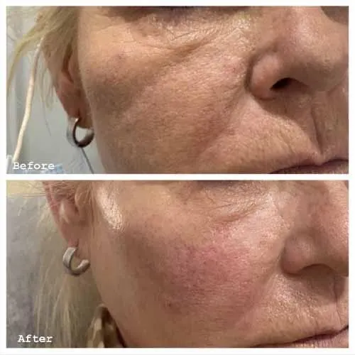 Cheek Filler