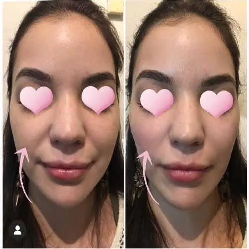 Cheek Filler