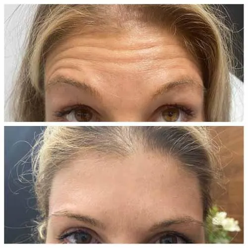 Forehead Lines