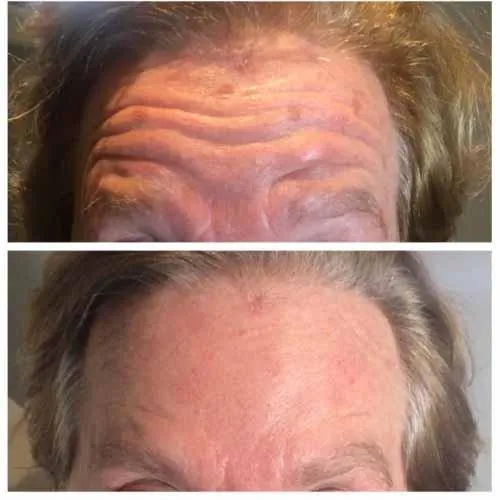 Forehead Lines