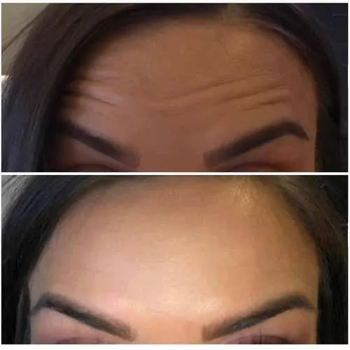 Forehead Lines