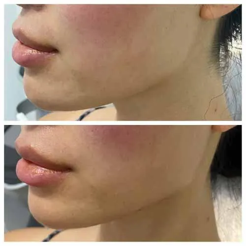 Cheek & Jaw Fille