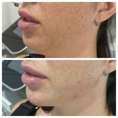 Cheek & Jaw Fille