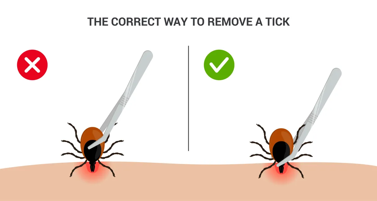 Learn how to safely remove a tick with Network Pest Control's guidance. Protect yourself from tick-borne illnesses. Discover proper tick removal in NW Arkansas.