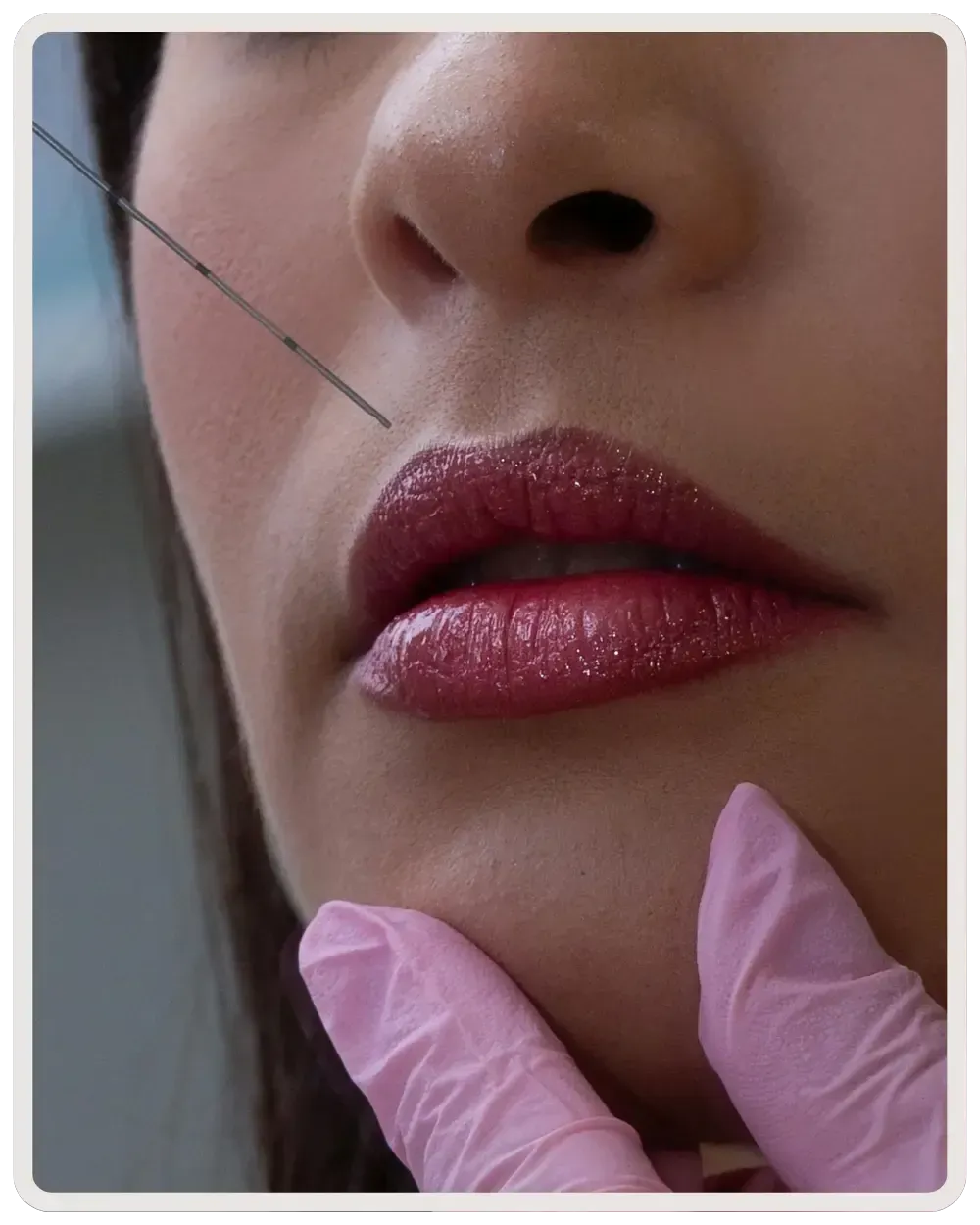 Dermal filler treatment for lips, cheeks, and chin at My Nurse Injector clinic in Toronto enhancing natural beauty