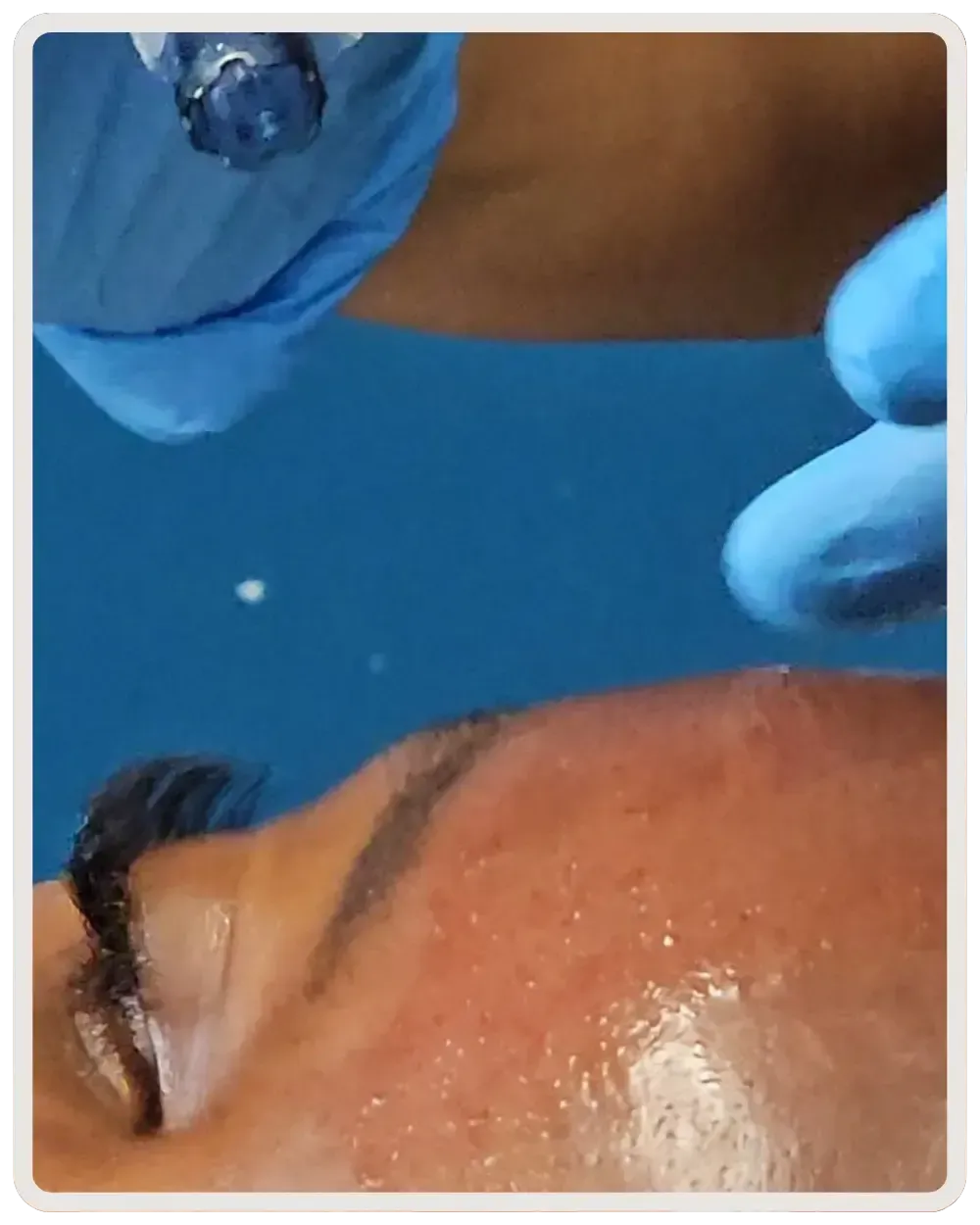 Platelet-rich plasma facial treatment at My Nurse Injector clinic in Toronto promoting natural skin rejuvenation