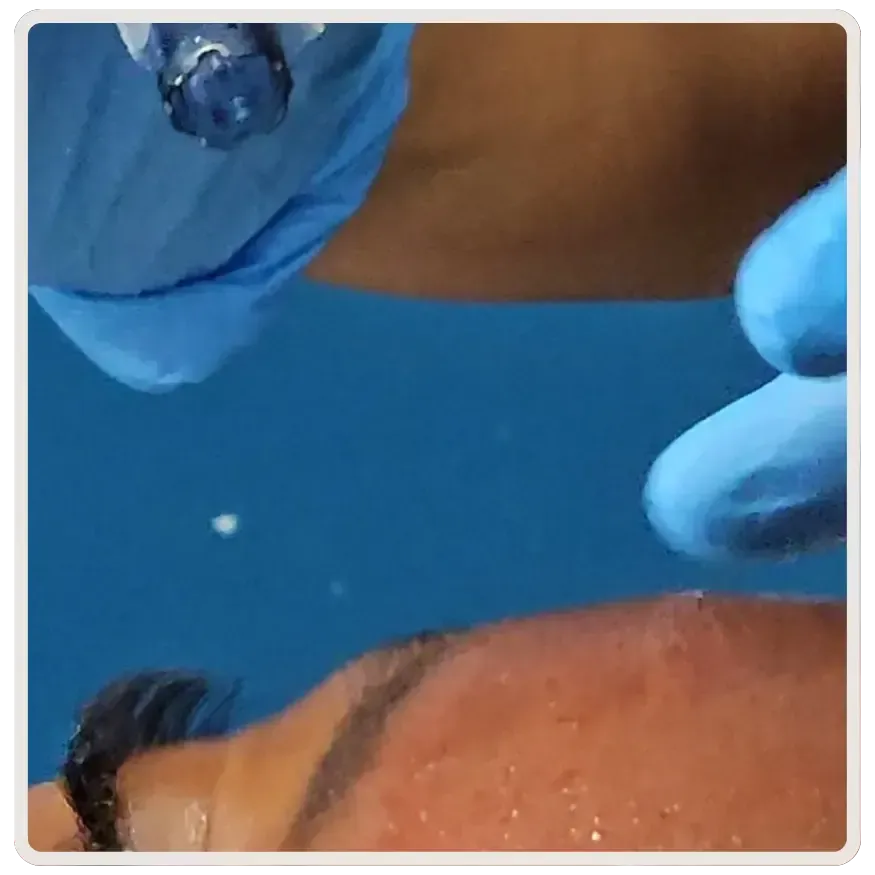 Renew your skin naturally with PRP facials combined with microneedling in Toronto. Stimulate collagen, fade scars, and achieve radiant, youthful skin.