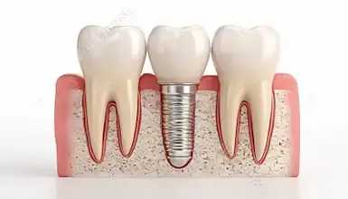single tooth implants 