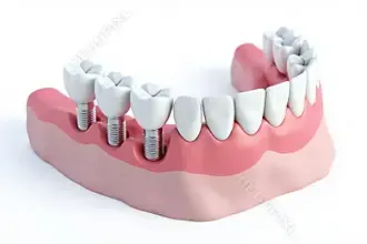 multiple teeth implants 