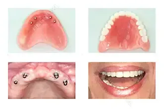 full mouth implants 