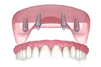 all on 4 dental implants 