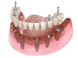 all on 6 dental implants 
