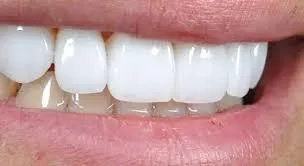 E max Veneers 