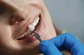 porclain veneers 