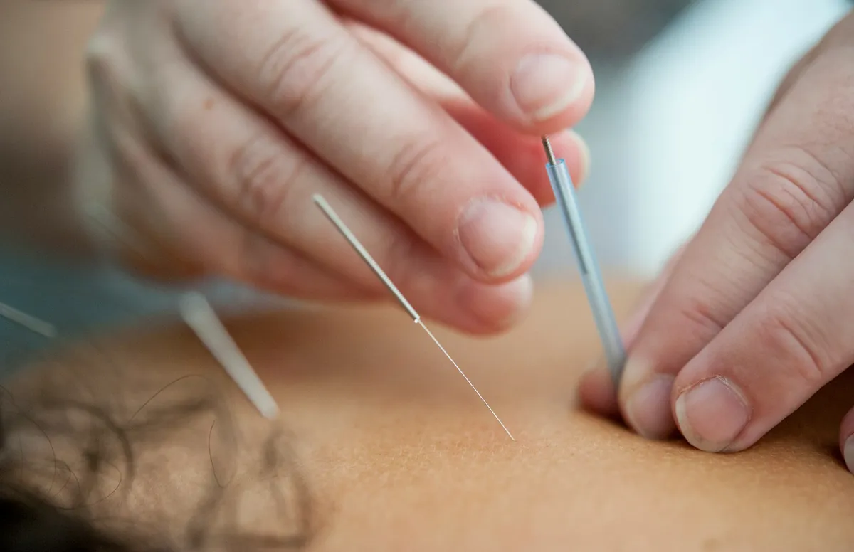 What Acupuncture in Vancouver Can Offer Women with PCOS Symptoms