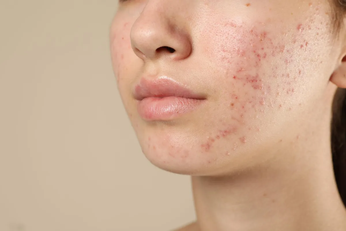 Acne Mapping in Vancouver: Jawline vs. Forehead Breakouts and What They Suggest