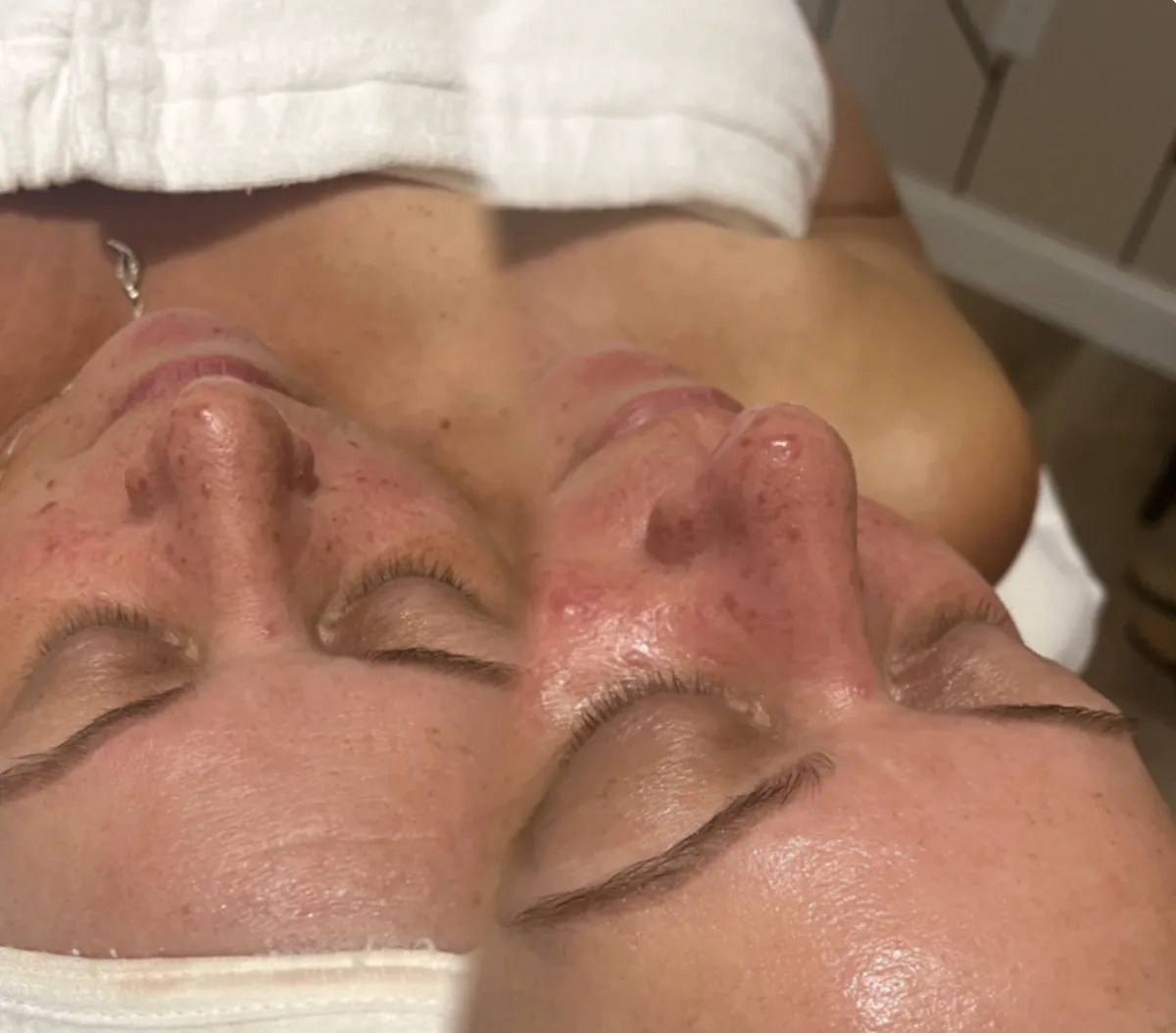 Needle-Free Filler Facial in Bensalem, PA by Sorella Beauty Studio