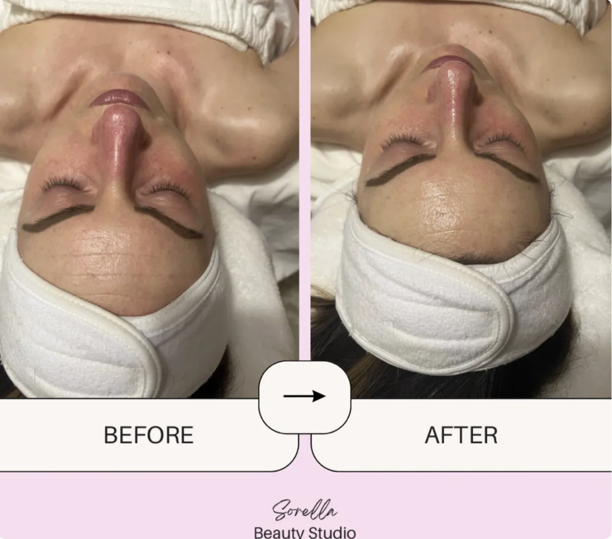 Plump & Glow Facial in Bensalem, PA by Sorella Beauty Studio