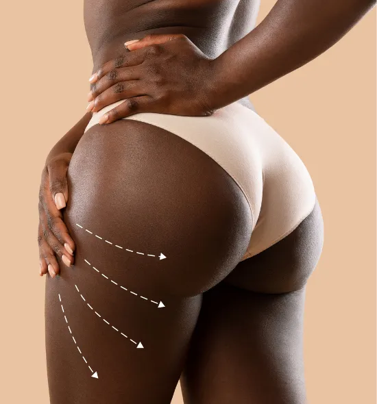 Close-up of a woman’s lower back and thighs in beige underwear, with white dashed arrows pointing upward—illustrating targeted lifting and contouring effects from Avéli cellulite treatment.