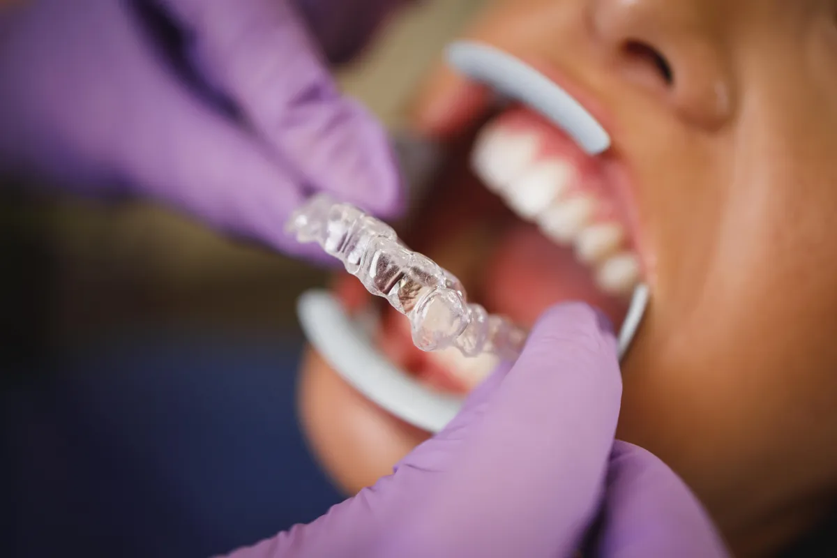 Florida Digital Aligner