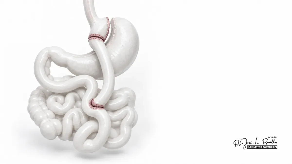 Bypass gástrico en Ecuador: beneficios y riesgos | Dr. Bonilla