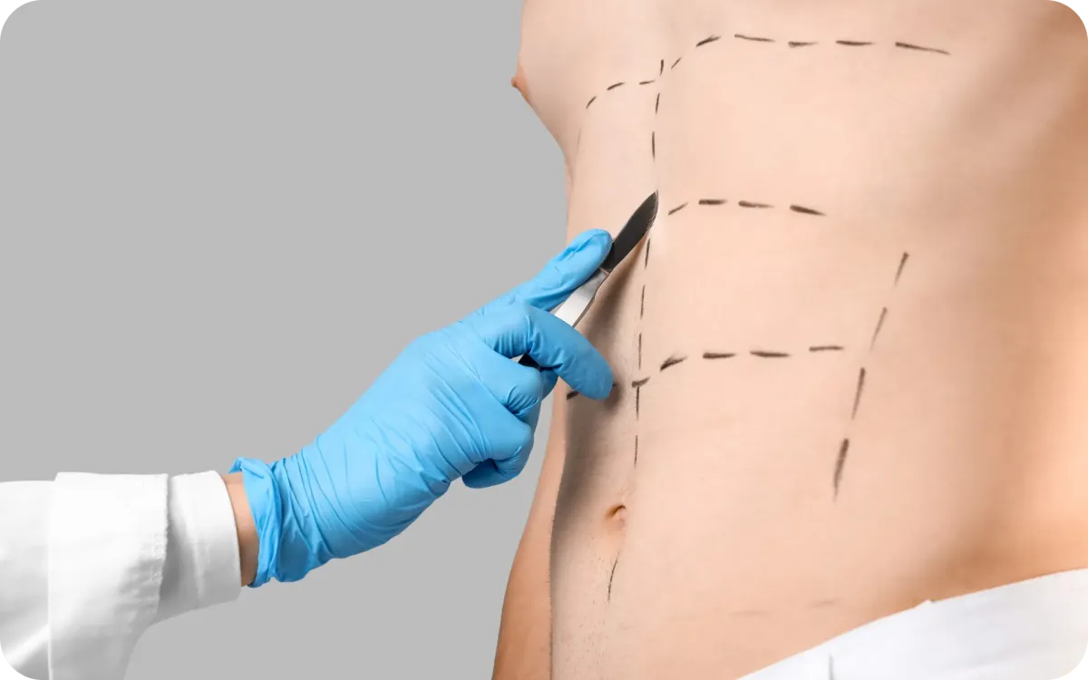 disegno addome criolipolisi