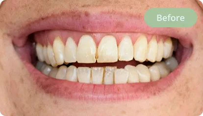 Before treatment