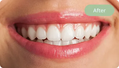 After treatment