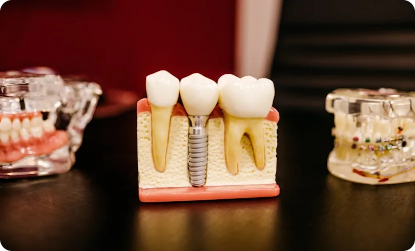 Dental Implants