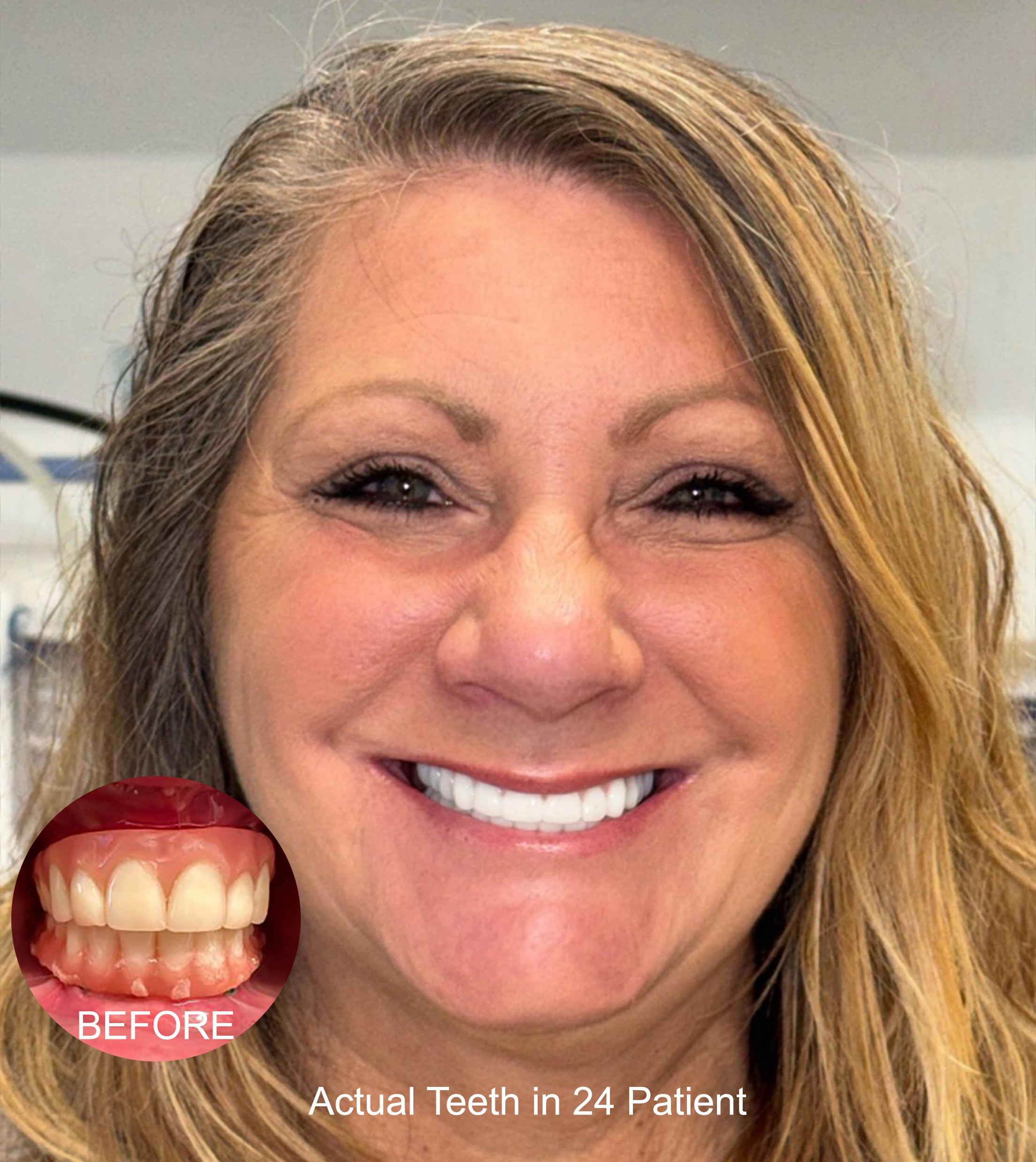Teeth in 24 Smile Makeover