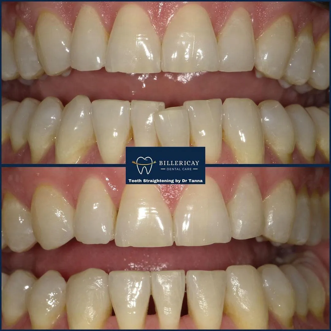 Teeth Straightening Open Day Billericay Dental Care