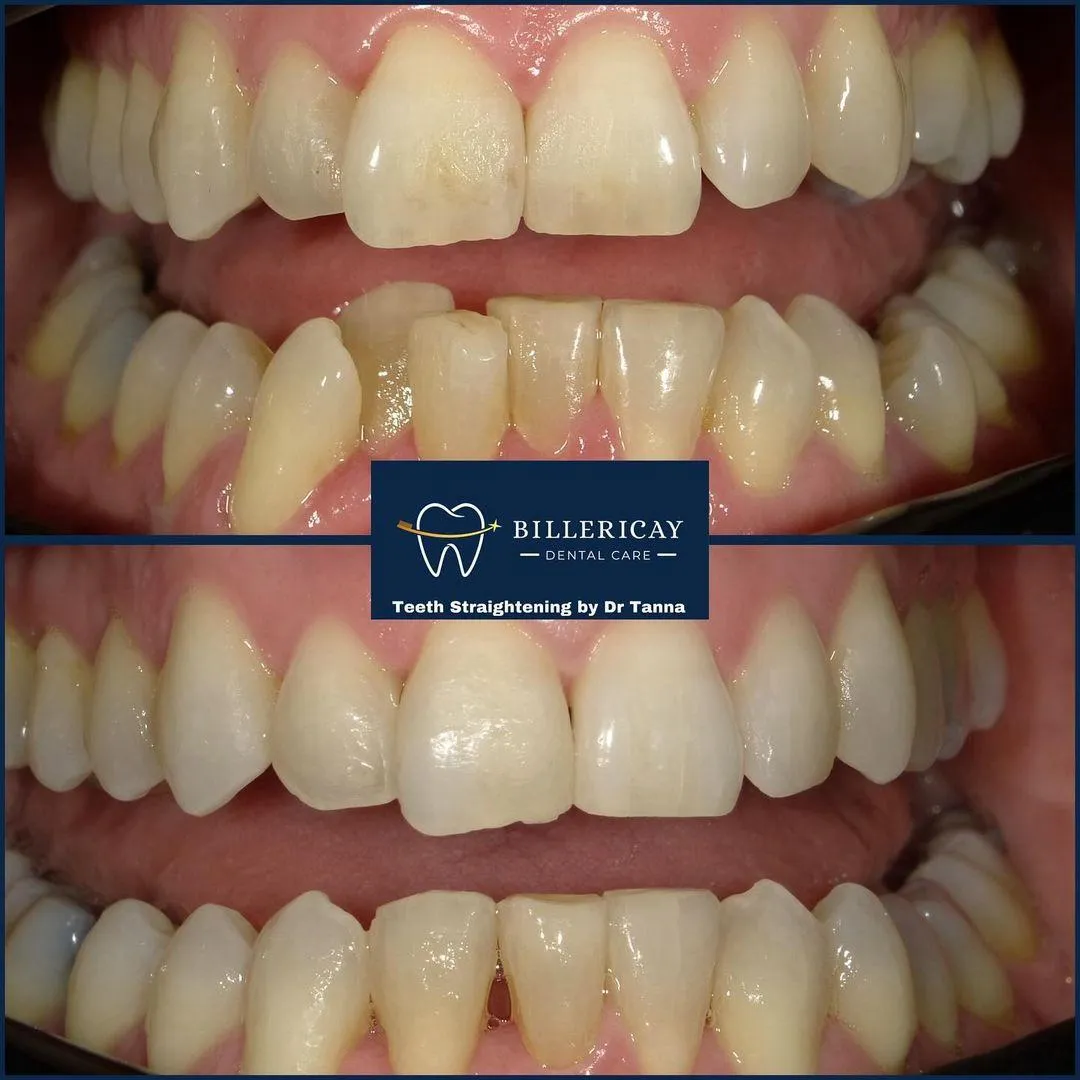 Teeth Straightening Open Day Billericay Dental Care