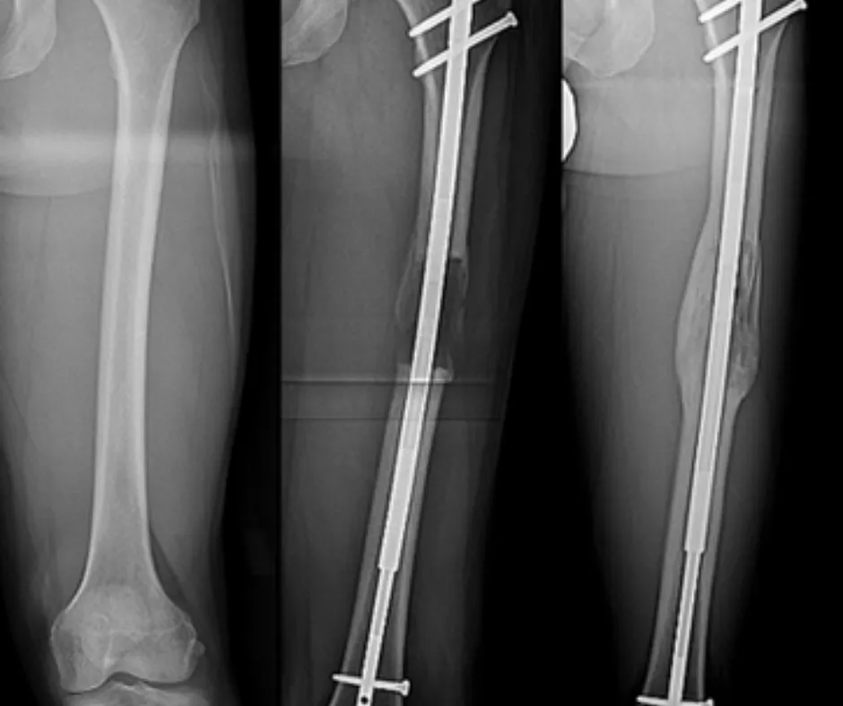 Dr. Taylor Reif Limb Lengthening & Deformity Correction