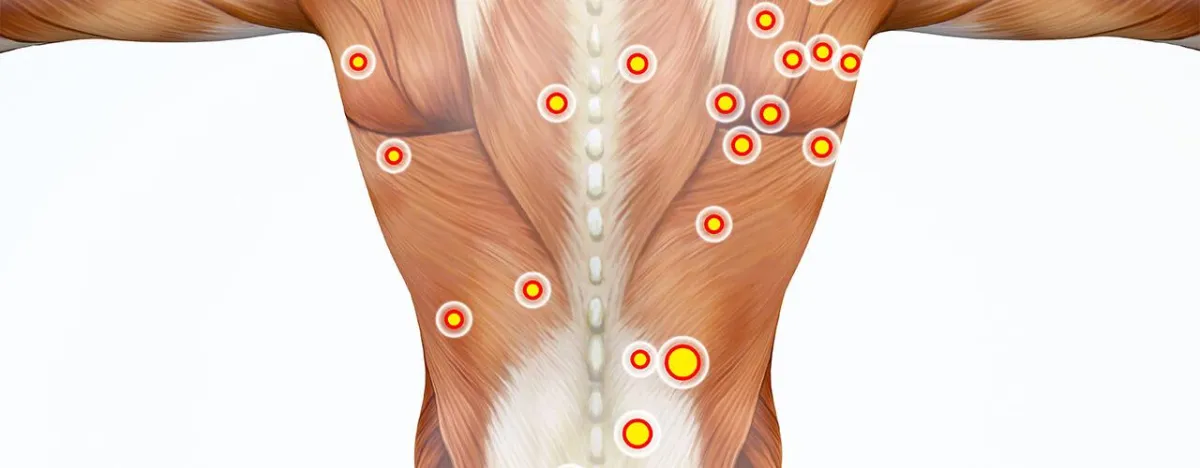 Trigger point therapy session focused on back and neck pain relief