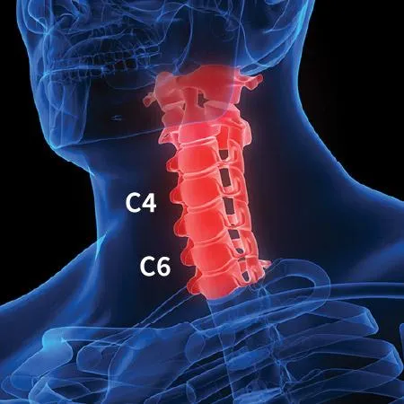 DSR injection locations at c4 & c6