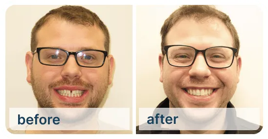 Braces for Kids