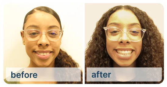 Braces for Kids