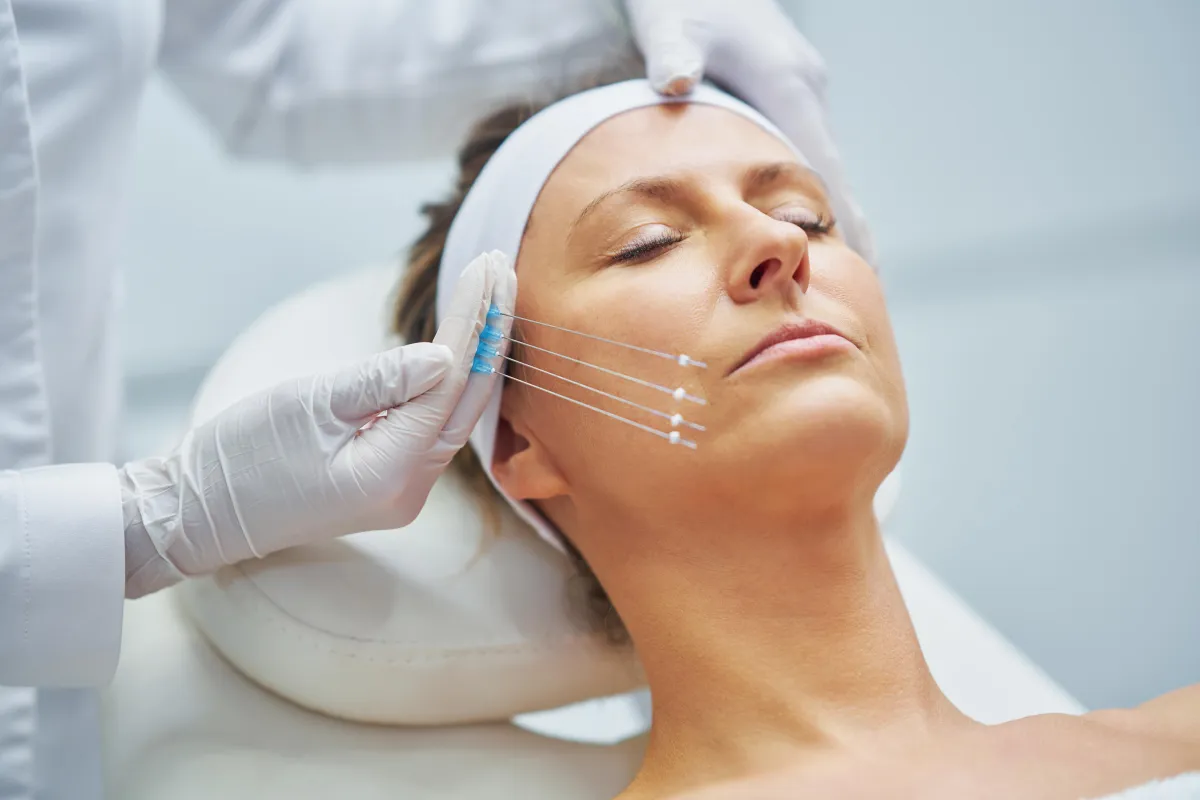 Fadenlifting in der Praxis Cosmedea in Bad Schönborn