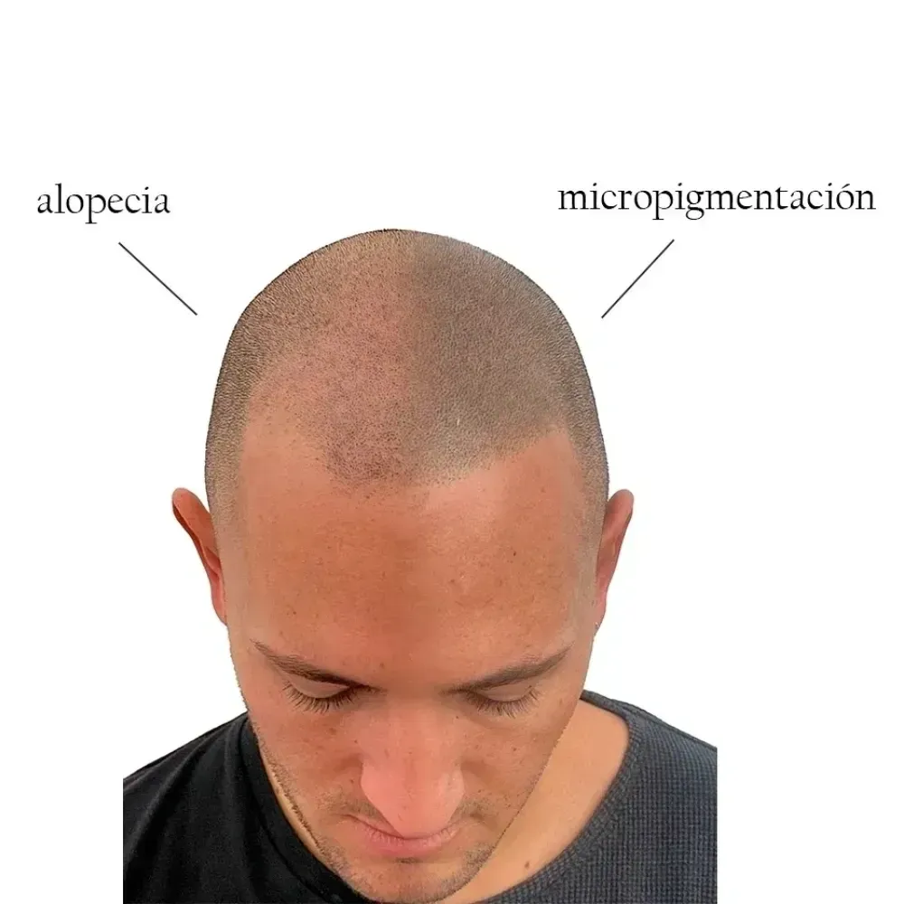 Micropigmentacion Capilar vs Alopecia