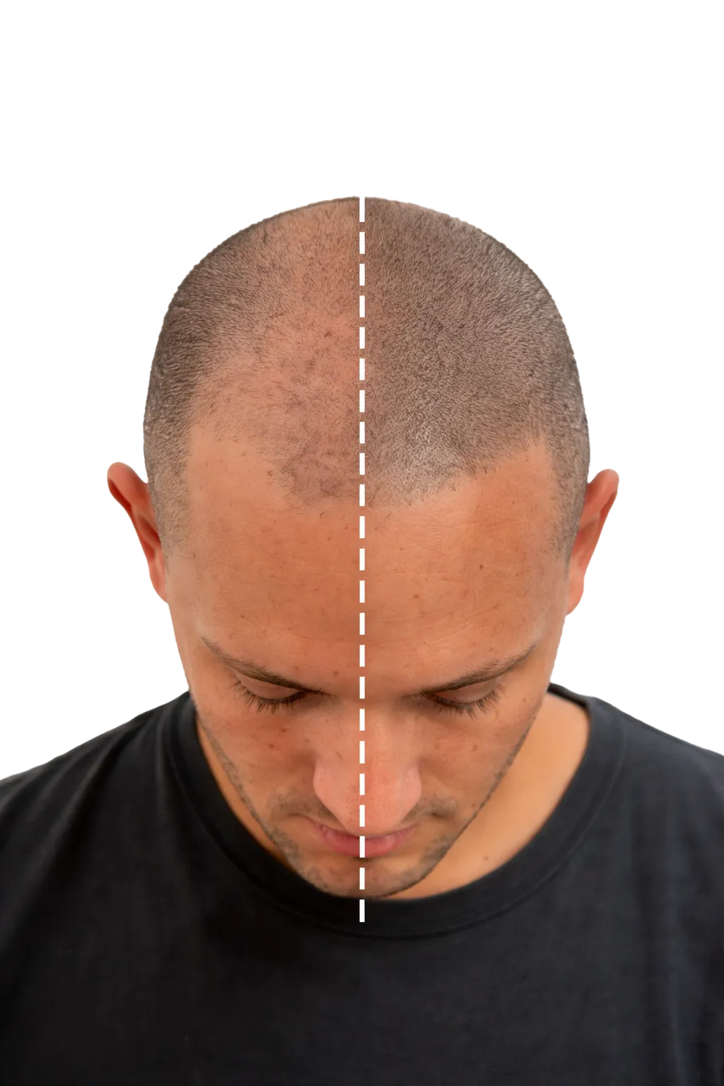 micropigmentacion capilar