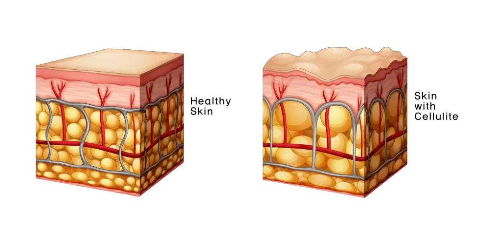 Cellulite Skin Diagram