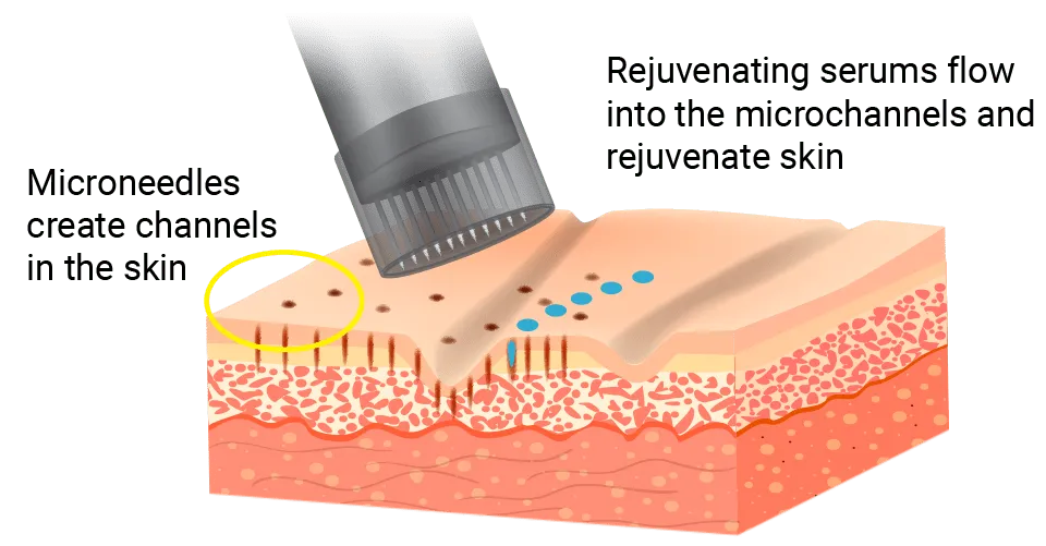 benefits of microchanneling