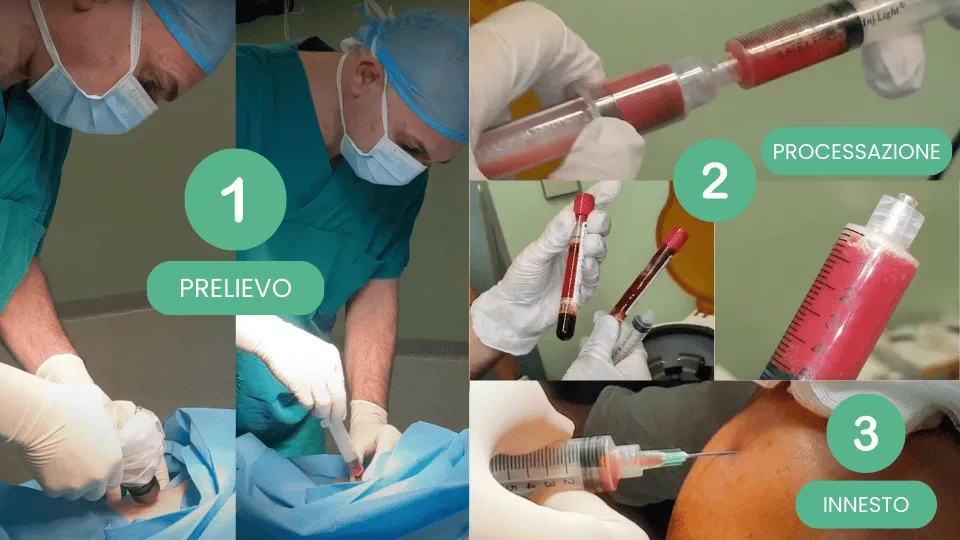 La procedura del trattamento con cellule staminali prelevate dalla Tibia ed infltrate nel ginocchio o spalla